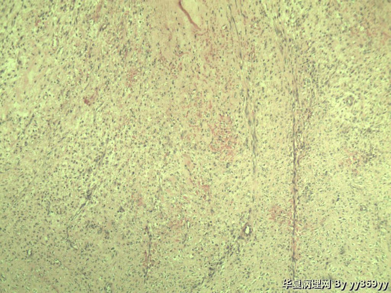 恶性的血管瘤??图29