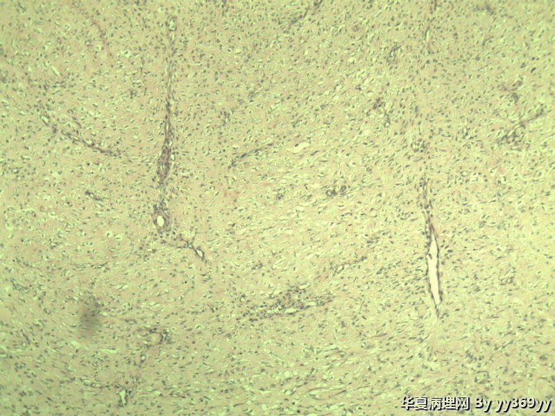 恶性的血管瘤??图30