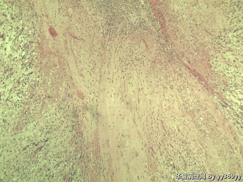 恶性的血管瘤??图31