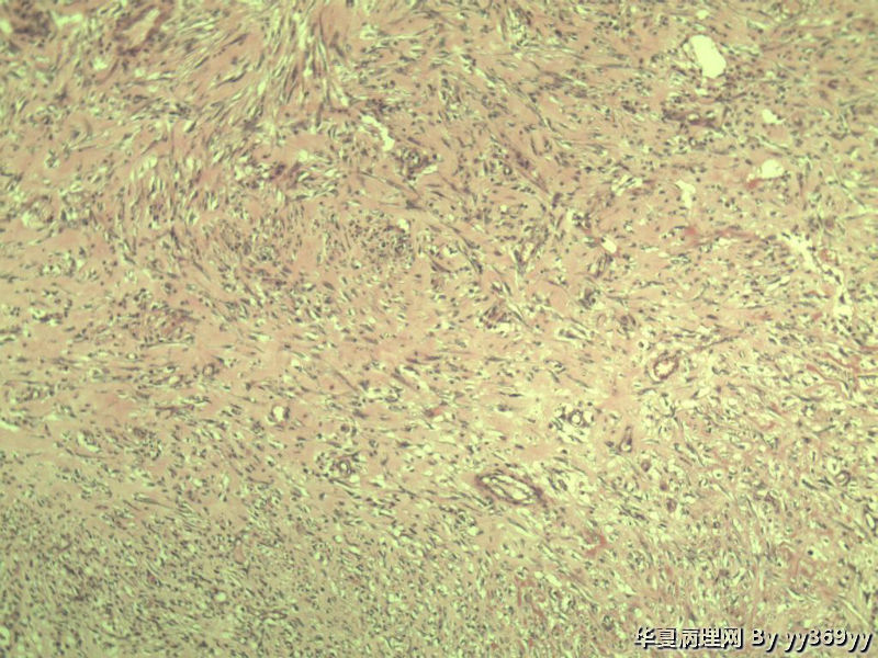 恶性的血管瘤??图32