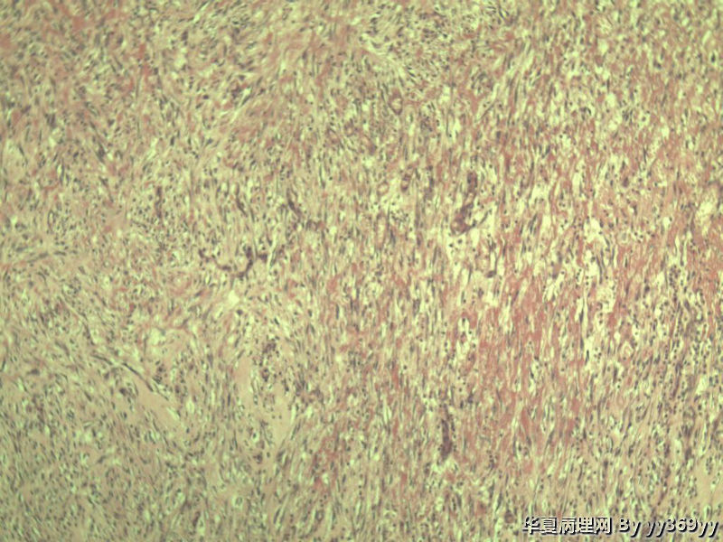 恶性的血管瘤??图33