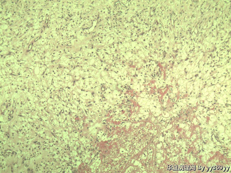 恶性的血管瘤??图34