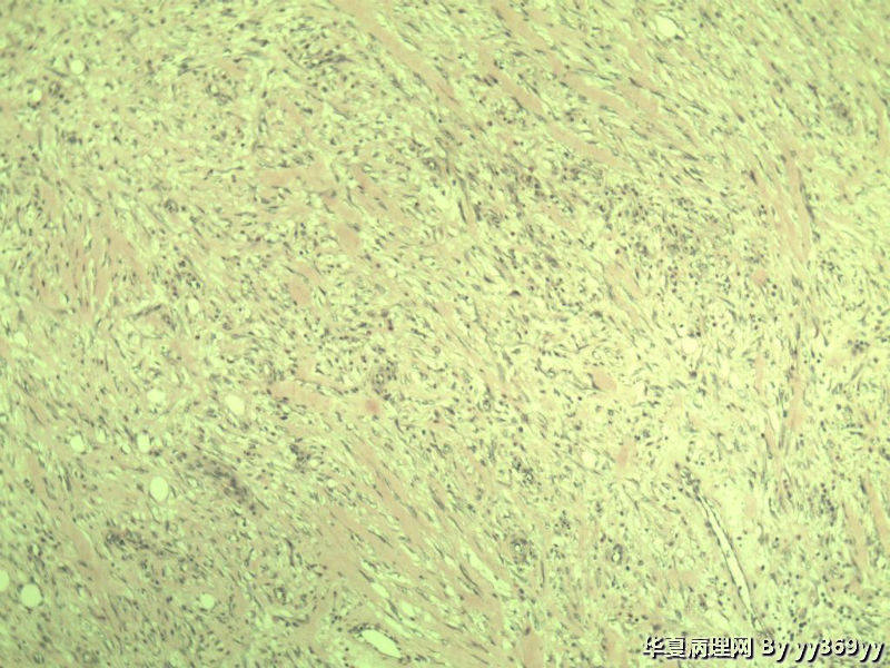 恶性的血管瘤??图35