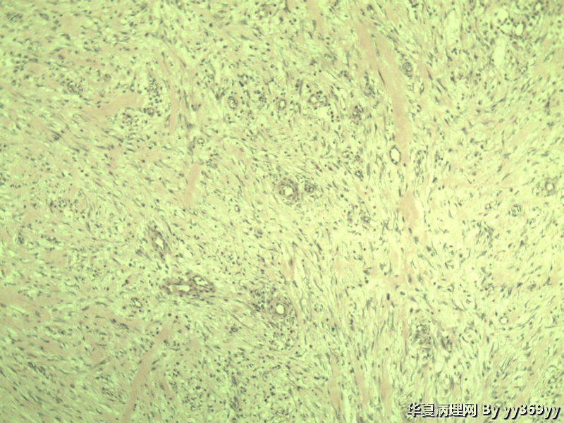 恶性的血管瘤??图36