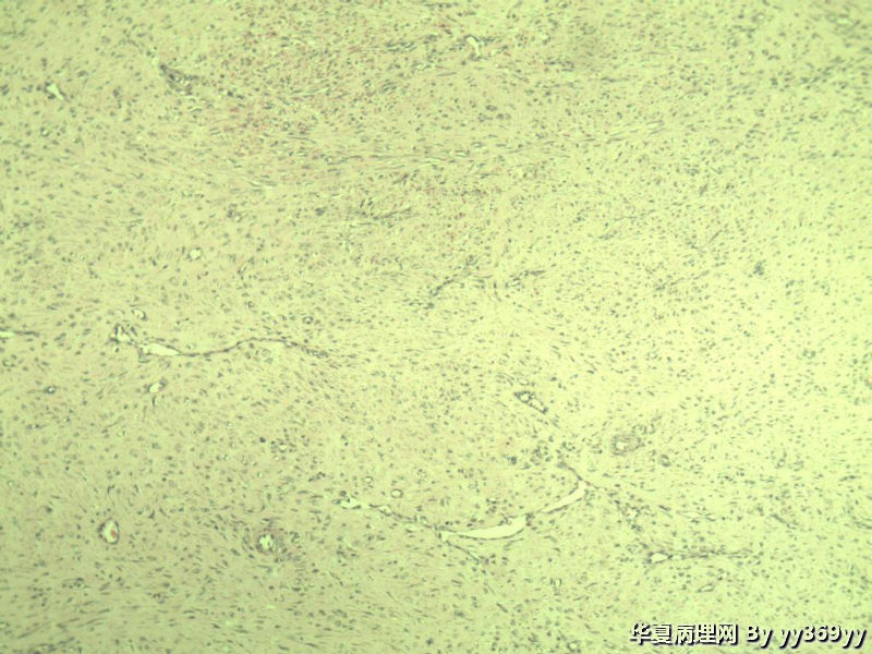 恶性的血管瘤??图37