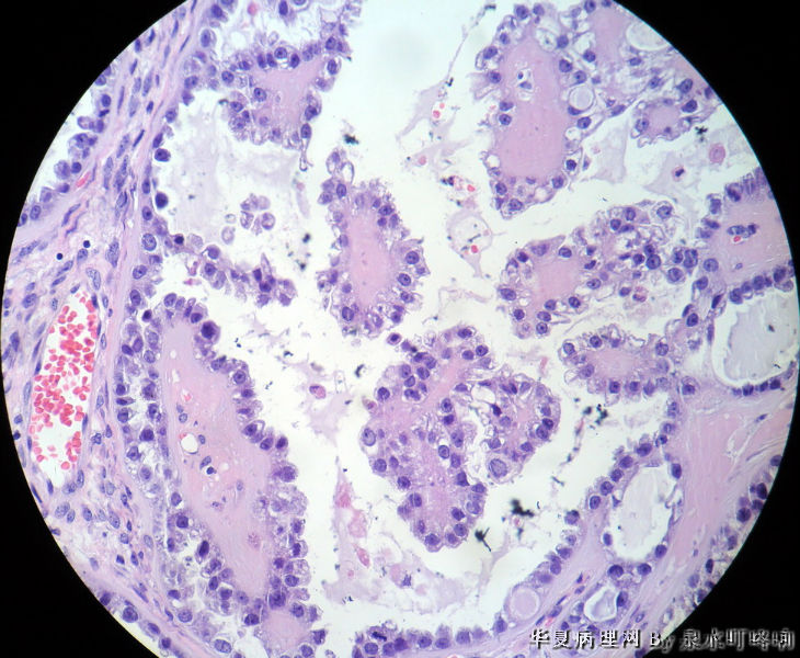 左卵巢肿物图10