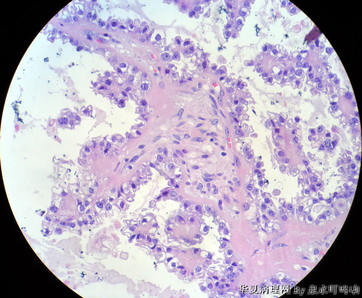 左卵巢肿物图11
