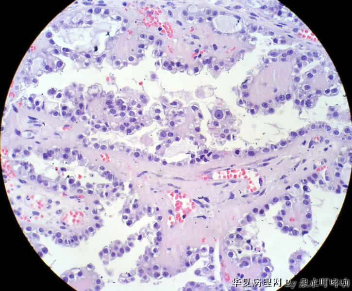 左卵巢肿物图12
