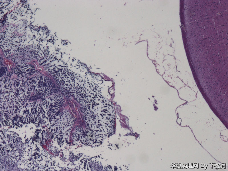 左侧颞叶及胼胝体膝部占位图1