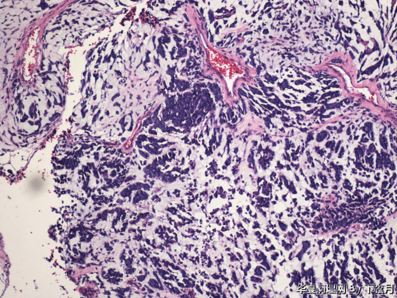 左侧颞叶及胼胝体膝部占位图2