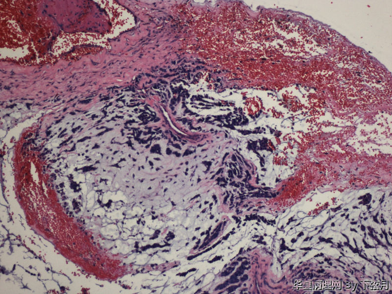 左侧颞叶及胼胝体膝部占位图3