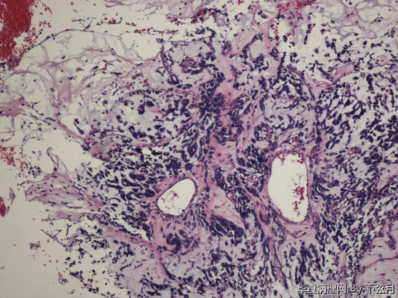左侧颞叶及胼胝体膝部占位图4