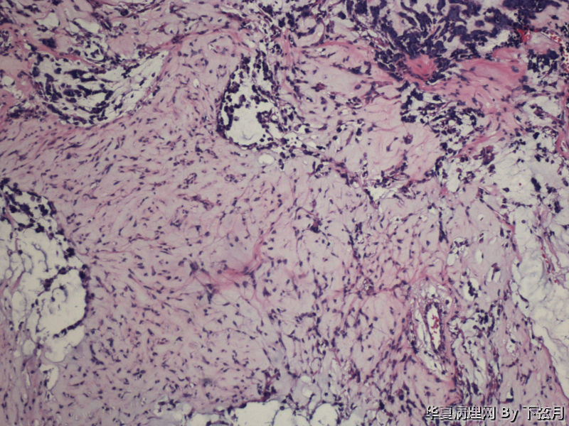 左侧颞叶及胼胝体膝部占位图5