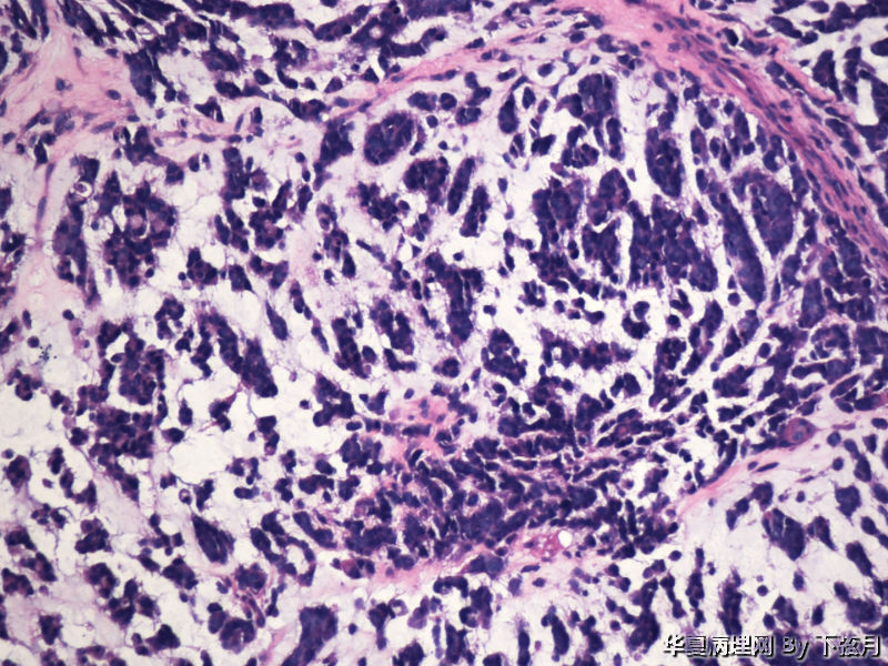 左侧颞叶及胼胝体膝部占位图6