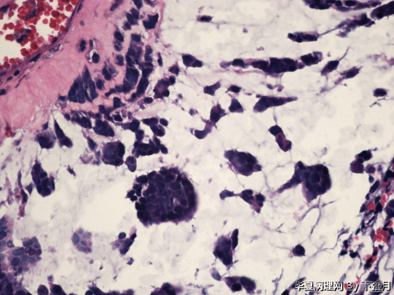 左侧颞叶及胼胝体膝部占位图7