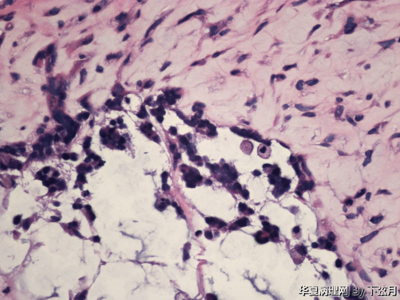 左侧颞叶及胼胝体膝部占位图8