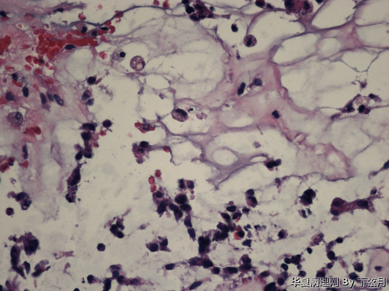 左侧颞叶及胼胝体膝部占位图9