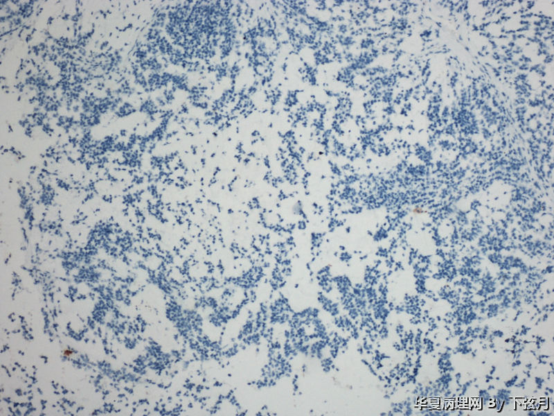 左侧颞叶及胼胝体膝部占位图10