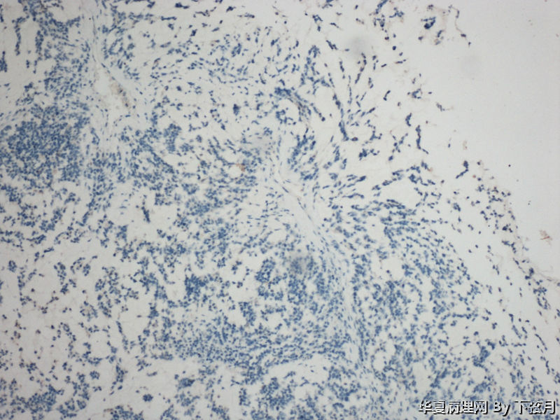 左侧颞叶及胼胝体膝部占位图11