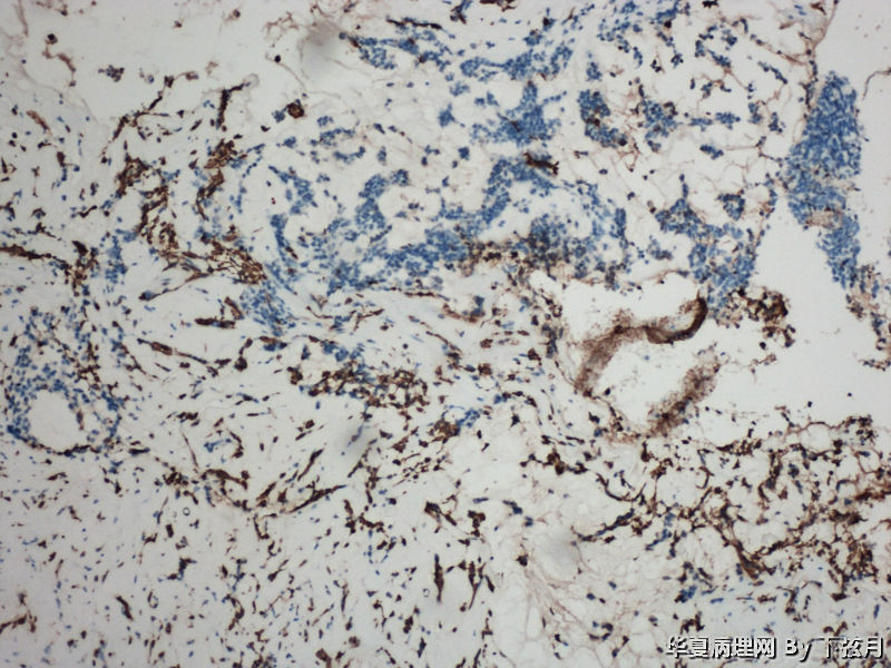 左侧颞叶及胼胝体膝部占位图12