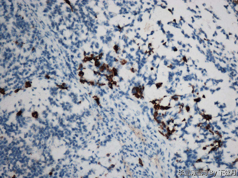 左侧颞叶及胼胝体膝部占位图13