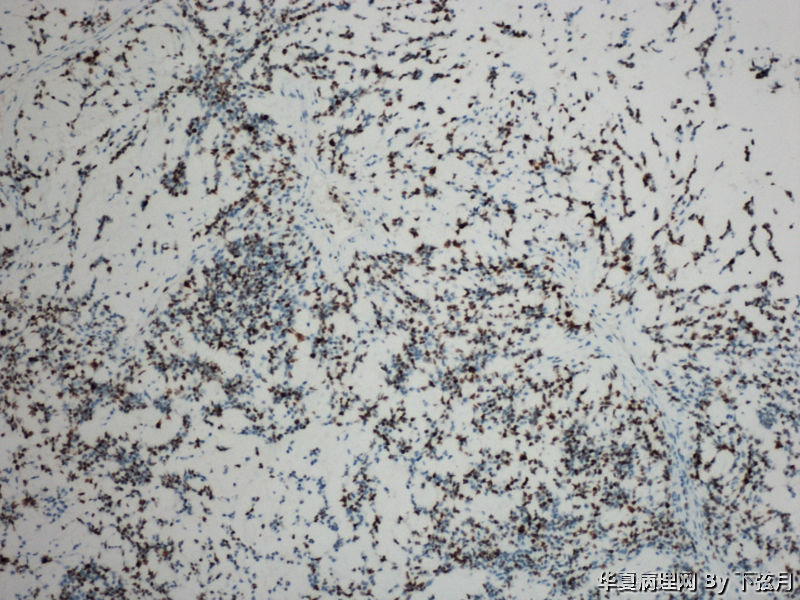 左侧颞叶及胼胝体膝部占位图14