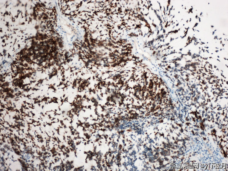 左侧颞叶及胼胝体膝部占位图15