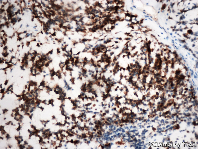 左侧颞叶及胼胝体膝部占位图16