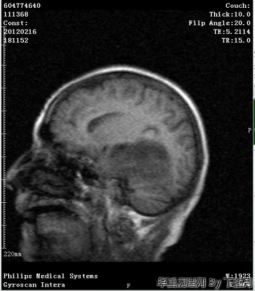 左侧颞叶及胼胝体膝部占位图17