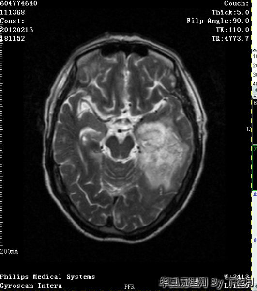 左侧颞叶及胼胝体膝部占位图18