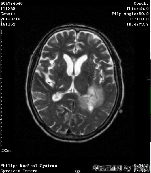 左侧颞叶及胼胝体膝部占位图20