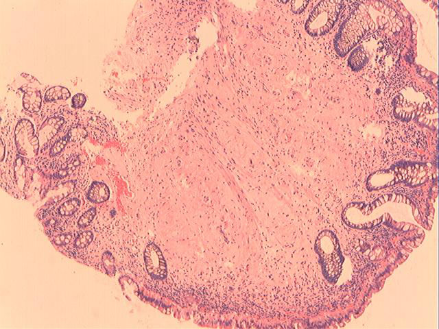 男性，46岁，腹痛2年。直肠处见一0.4cm大小的息肉。图1