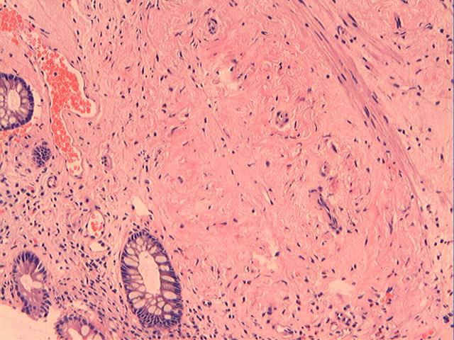 男性，46岁，腹痛2年。直肠处见一0.4cm大小的息肉。图2