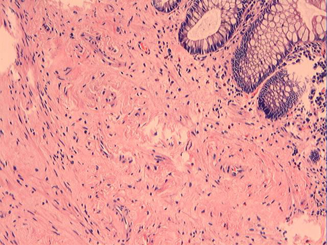 男性，46岁，腹痛2年。直肠处见一0.4cm大小的息肉。图3