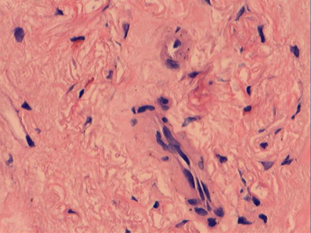 男性，46岁，腹痛2年。直肠处见一0.4cm大小的息肉。图4