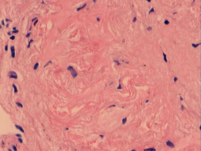 男性，46岁，腹痛2年。直肠处见一0.4cm大小的息肉。图5