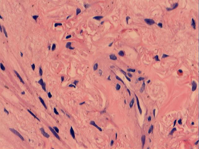 男性，46岁，腹痛2年。直肠处见一0.4cm大小的息肉。图6