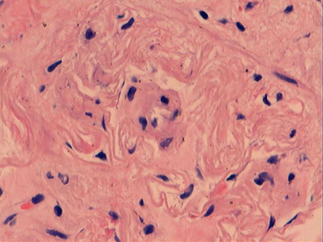 男性，46岁，腹痛2年。直肠处见一0.4cm大小的息肉。图7