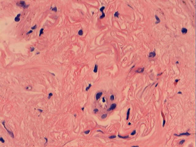 男性，46岁，腹痛2年。直肠处见一0.4cm大小的息肉。图8