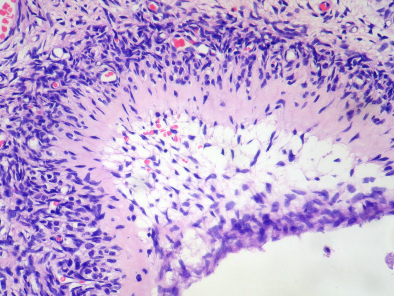 请教，这是卵巢的什么病变？图2