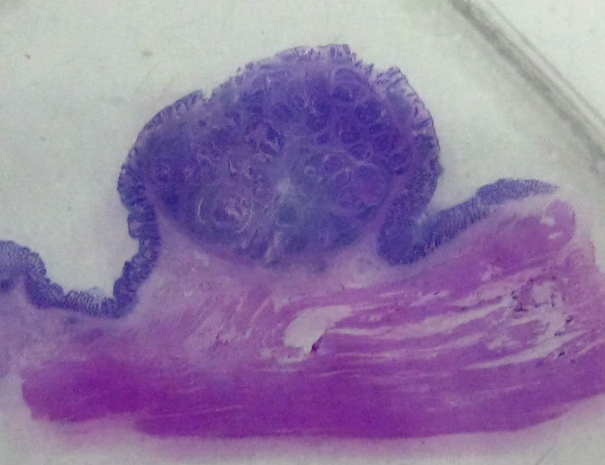 请教：这个乙状结肠肿瘤侵犯到哪一层？？图1