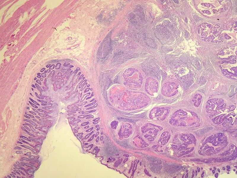 请教：这个乙状结肠肿瘤侵犯到哪一层？？图2