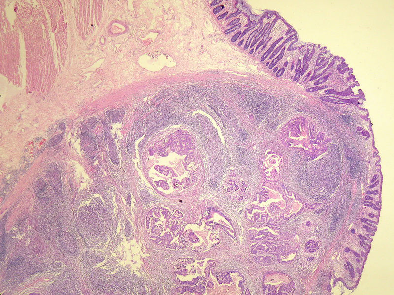请教：这个乙状结肠肿瘤侵犯到哪一层？？图3