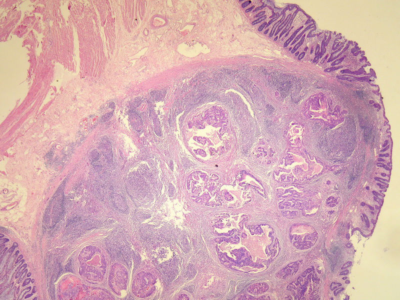 请教：这个乙状结肠肿瘤侵犯到哪一层？？图4