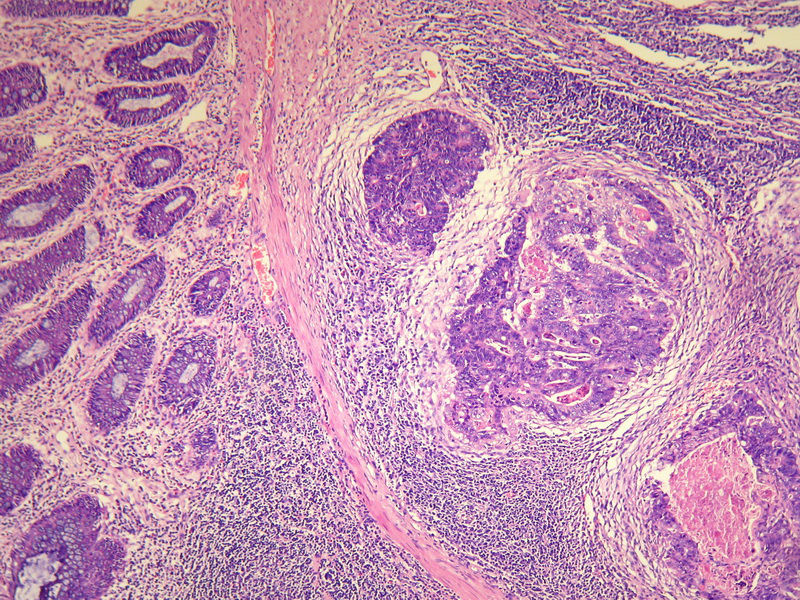 请教：这个乙状结肠肿瘤侵犯到哪一层？？图5