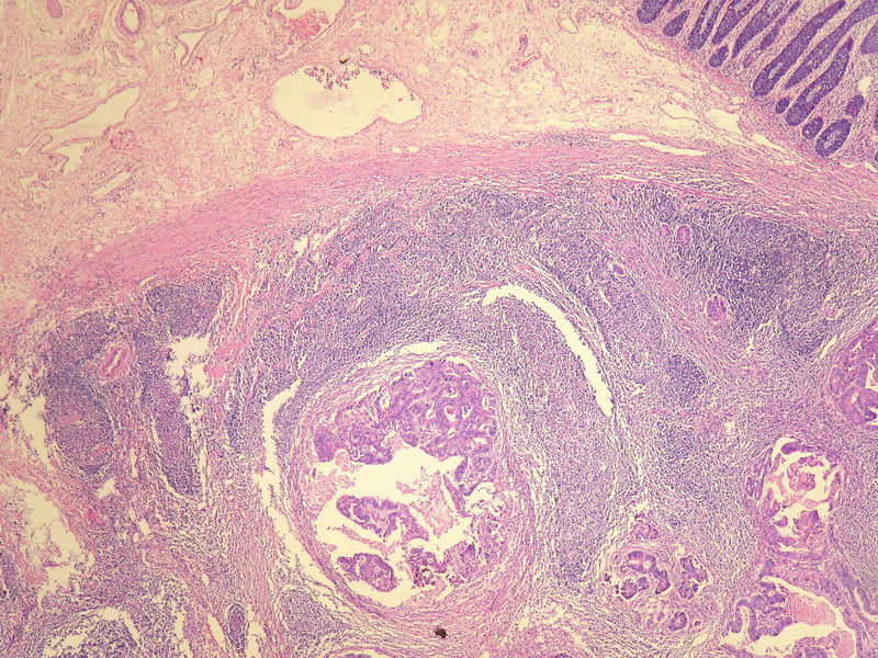 请教：这个乙状结肠肿瘤侵犯到哪一层？？图6
