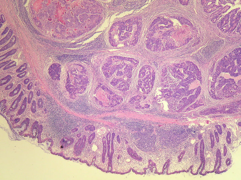 请教：这个乙状结肠肿瘤侵犯到哪一层？？图7