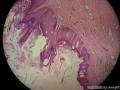 男性53岁 大腿包块一个月图2