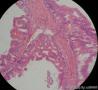 高分化粘液性囊腺癌吗，坏死之外的诊断依据？图11