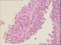 请教！膀胱新生物。图18